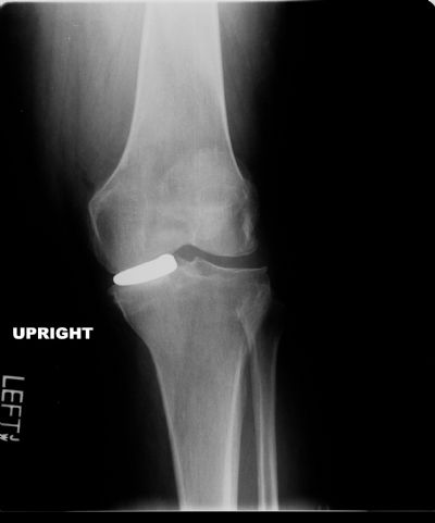 Orthoglide (Implant 617)